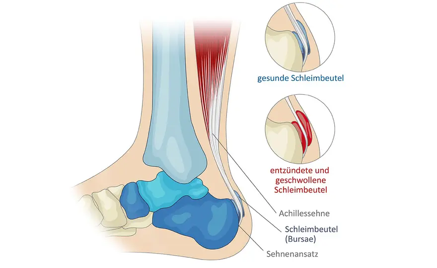 Achillessehne Lage - Anatomie, Funktion & Schmerz verstehen
