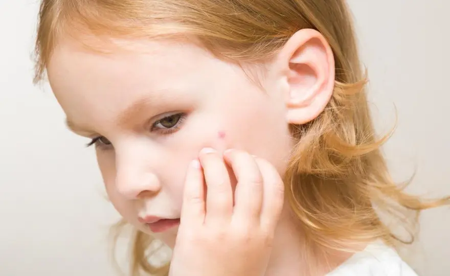 Cinquième maladie, des joues rouges aux plaques en dentelle