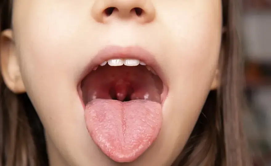 Czerwone plamki na podniebieniu u dziecka - Kiedy do lekarza?