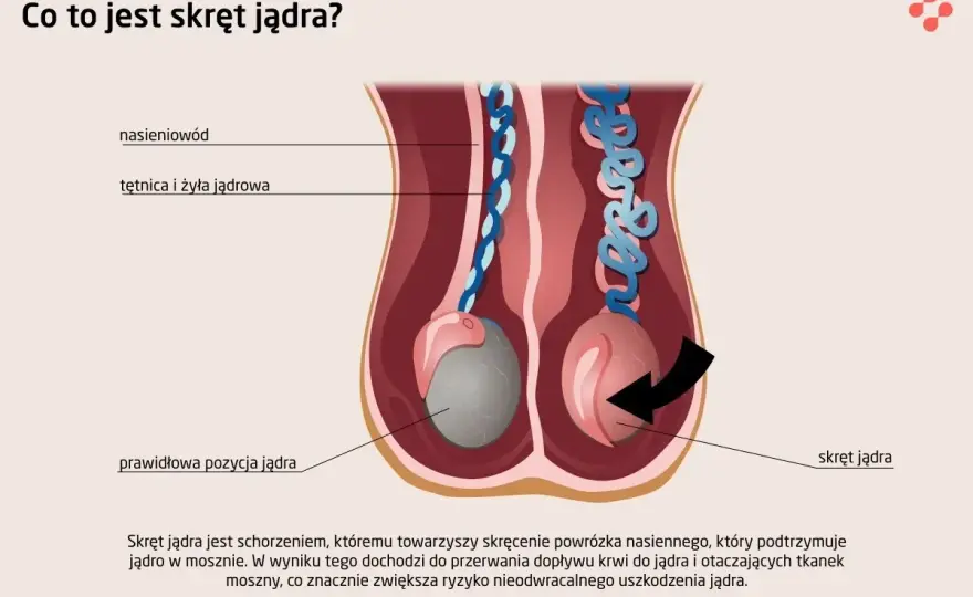 Skręt jądra - objawy, leczenie i co robić natychmiast?