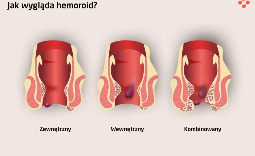 Rak odbytu czy hemoroidy? Objawy, diagnostyka i kiedy do lekarza