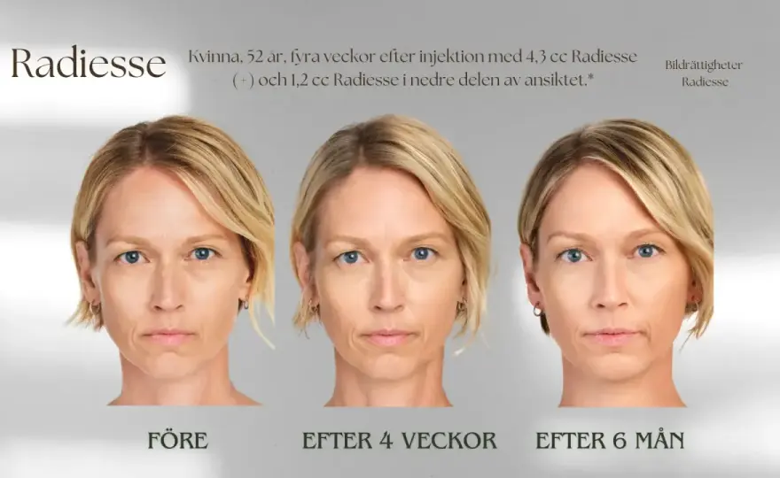 Radiesse behandling - Allt du behöver veta för naturligt resultat