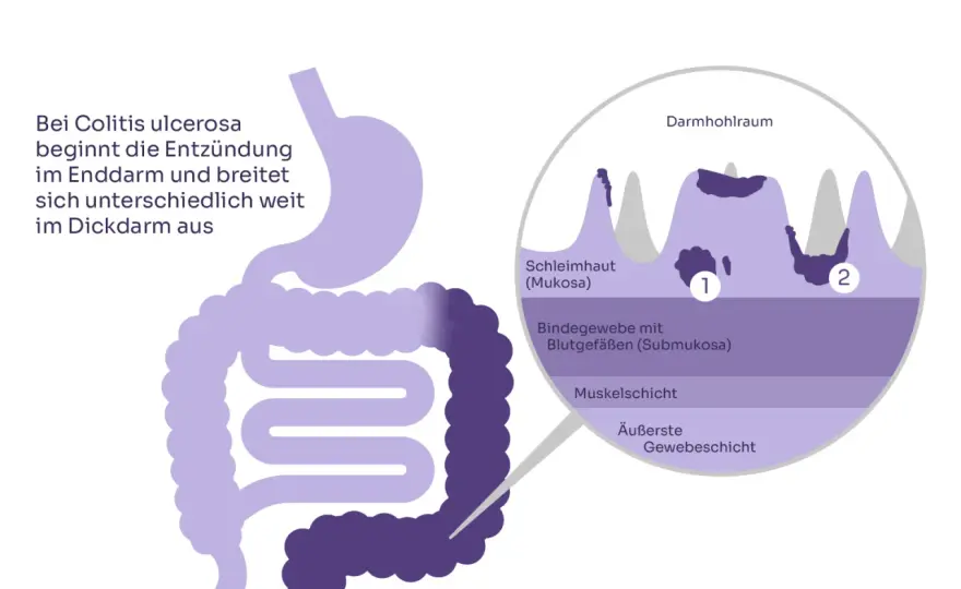 Colitis ulcerosa Symptome: Warnsignale, die Sie nicht ignorieren sollten