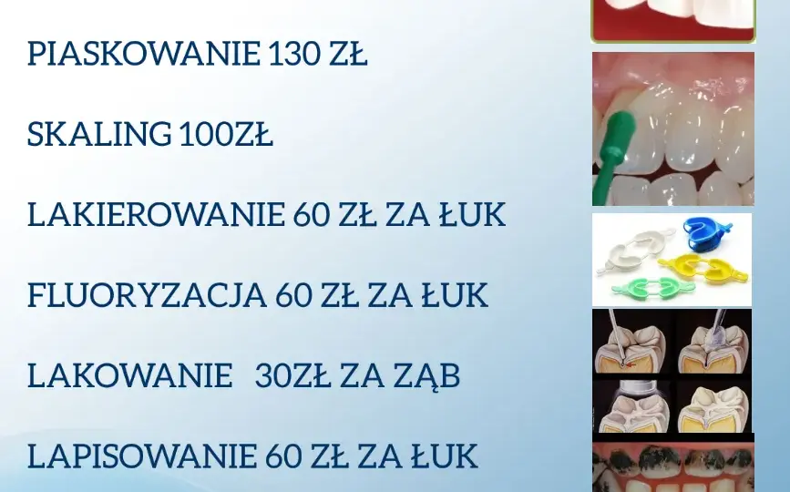 Koszt leczenia kanałowego zęba: Ceny, NFZ, na co uważać?