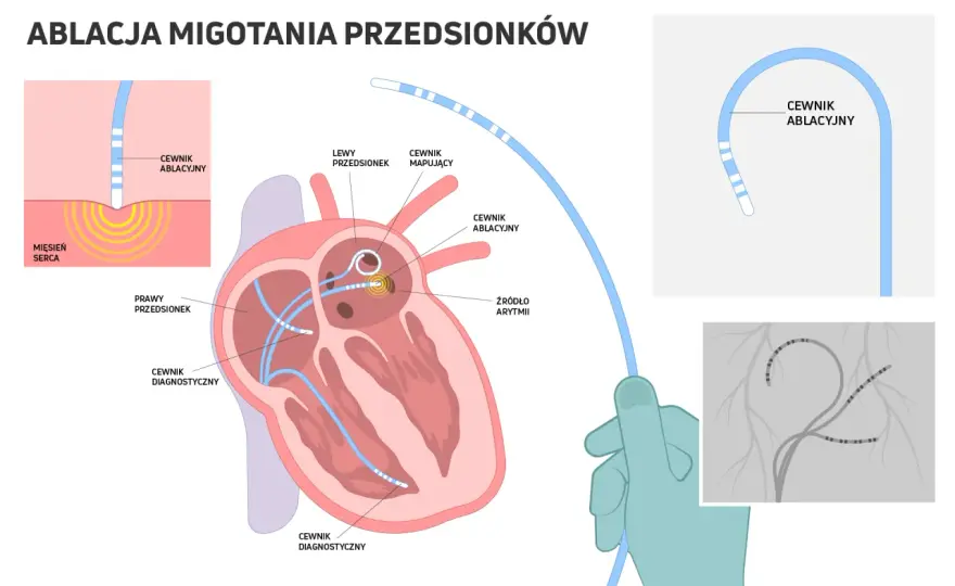 Ablacja serca - Na czym polega zabieg i jak wygląda rekonwalescencja?