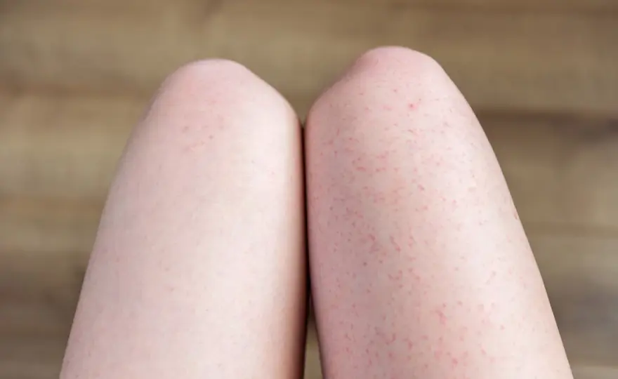 Haut nach dem Lasern - was normal ist und was hilft