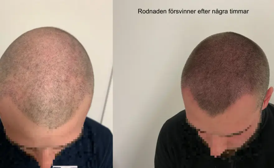 Hårbottenpeeling utan irritation - så väljer du rätt metod