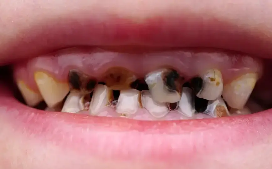 Jak wyleczyć próchnicę bez dentysty? Kiedy to możliwe?