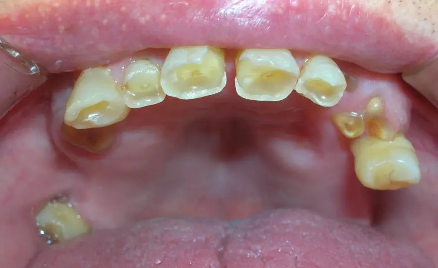 ¿La movilidad dental puede hacer caer los dientes de arriba?
