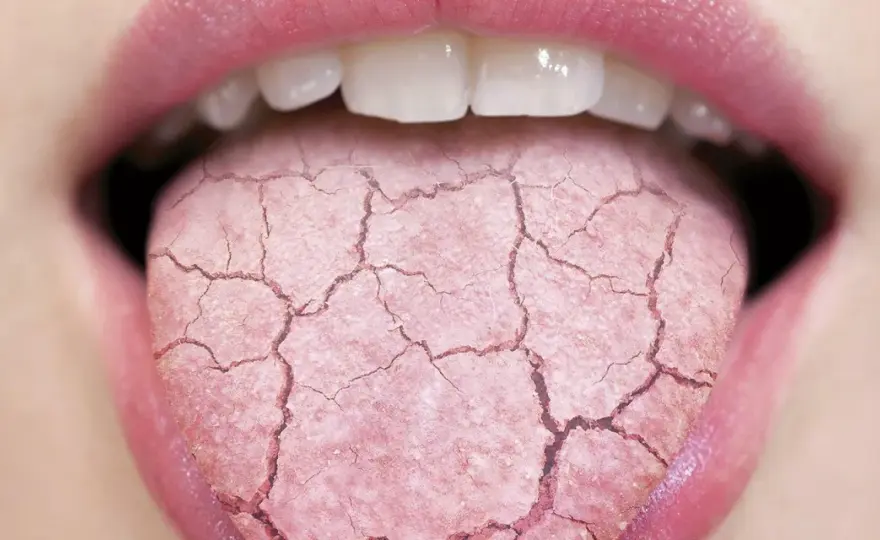 ¿Cómo aliviar el ardor bucal? Medidas y señales de alerta