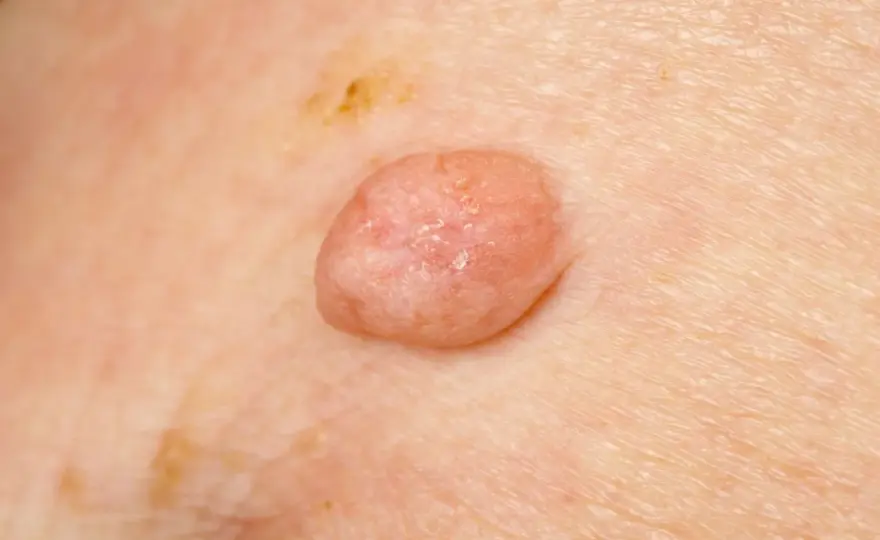 Objawy HPV - jak wyglądają i kiedy nie zwlekać z wizytą