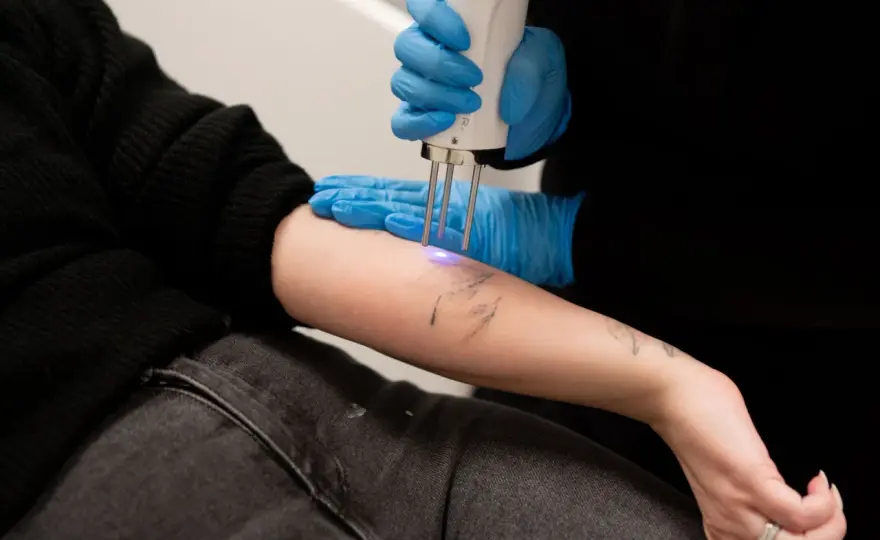 Tatueringsborttagning - Pris & Kostnad 2026: Vad du ska veta