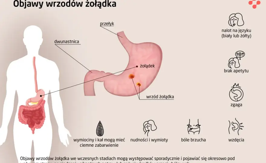 Wrzody żołądka - objawy, przyczyny i leczenie