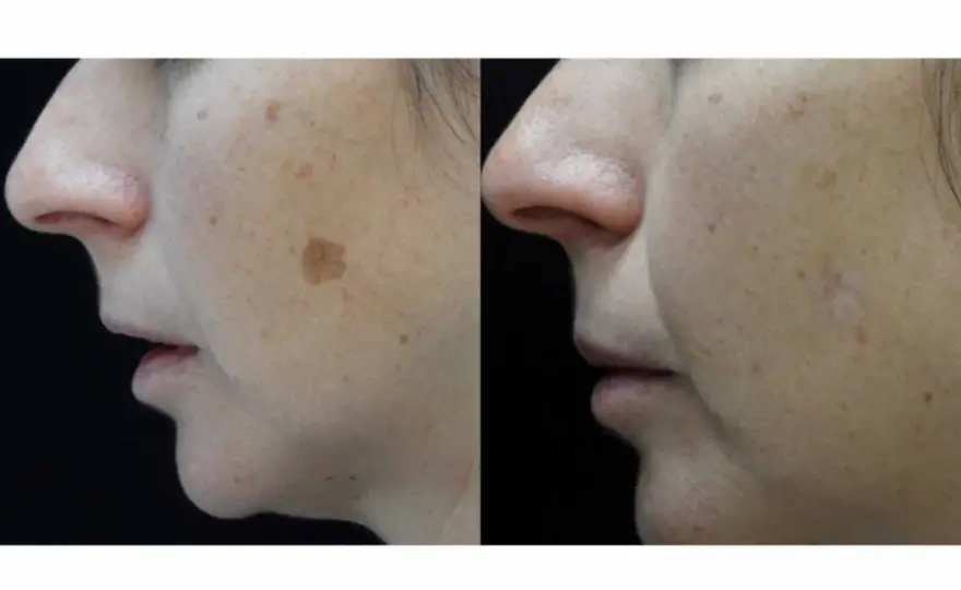 Manchas solares en la cara - Guía para eliminarlas y prevenirlas