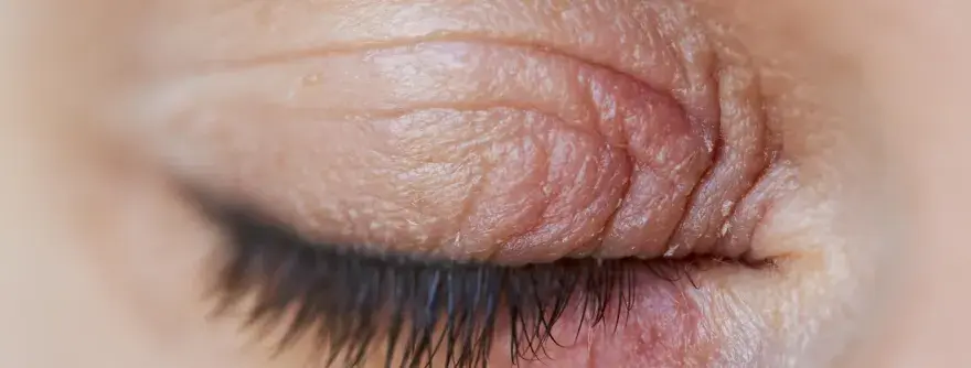 Paupière irritée - Causes et solutions efficaces