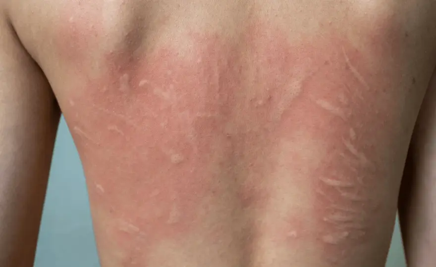 Orticaria bambini - Riconoscila subito e agisci bene