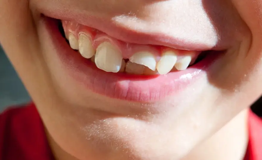 Dente spezzato, cosa fare e quali cure lo possono salvare
