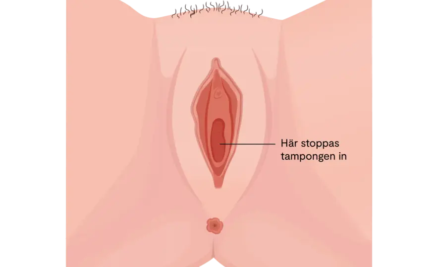 Besvär i underlivet efter samlag - irritation, svamp eller vaginos?