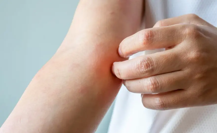 Prurito diffuso e pelle che punge - cause e segnali d’allarme