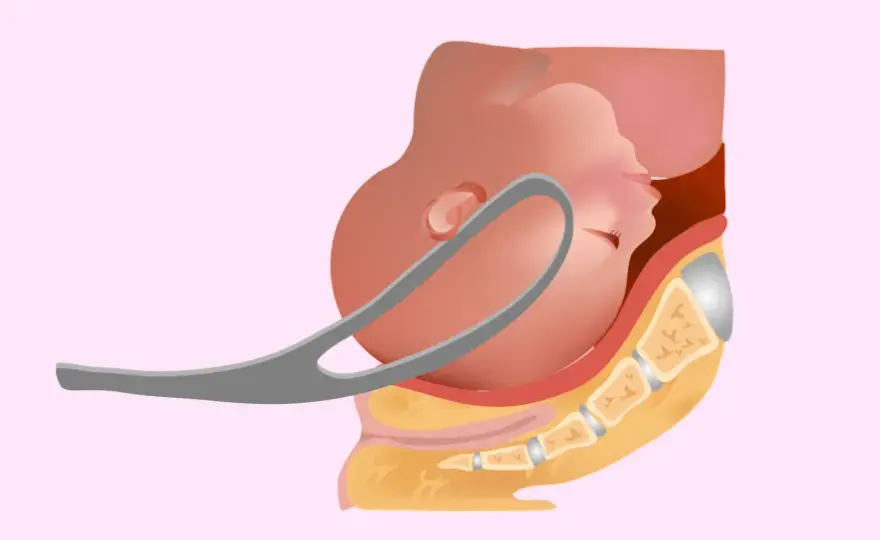 Parto con forcipe - Quando è errore medico?