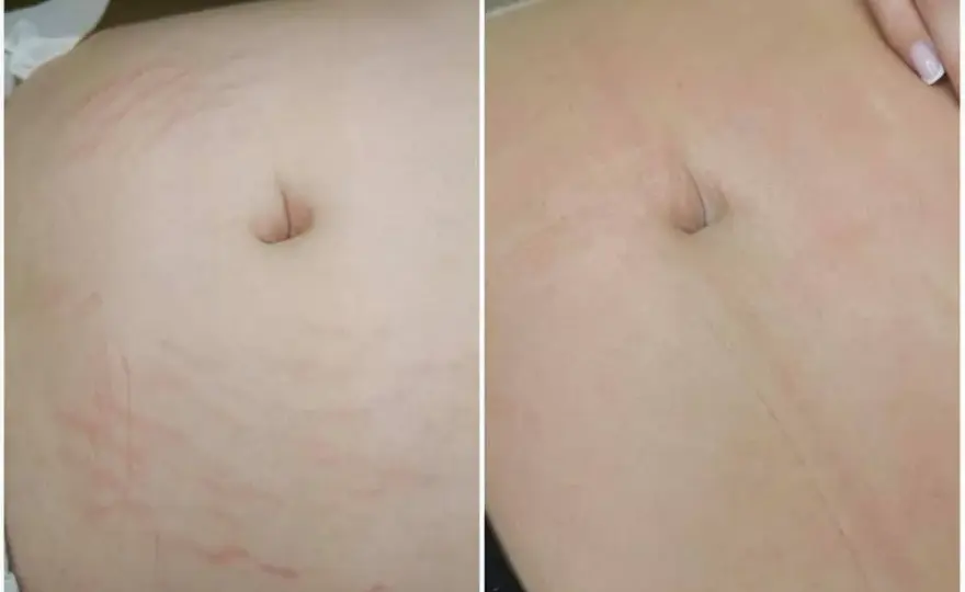 Gdzie kupić deep phyto peeling i uniknąć nieefektywnych produktów