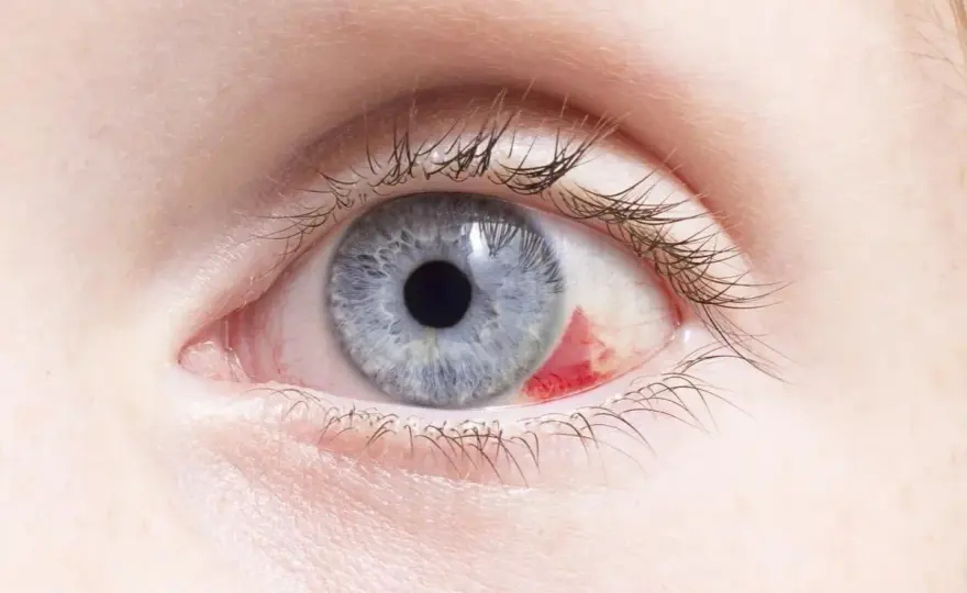 Ojo rojo en bebé - ¿Irritación o algo más? Guía práctica