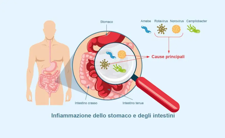 Gastroenterite, sintomi e rimedi per affrontarla senza errori