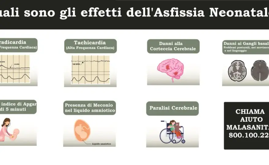 Meconio e danni cerebrali - Quando c'è nesso causale?