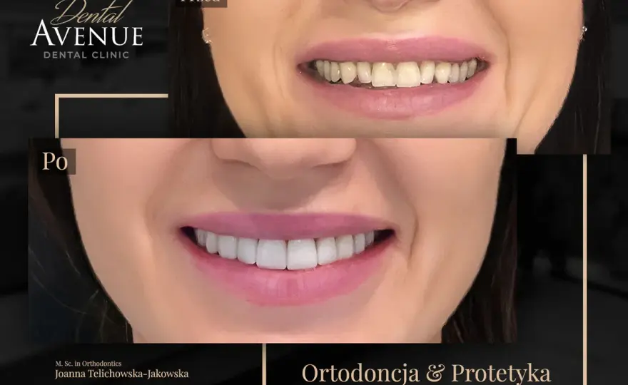 Ortodoncja przed i po - Co naprawdę zmienia aparat?