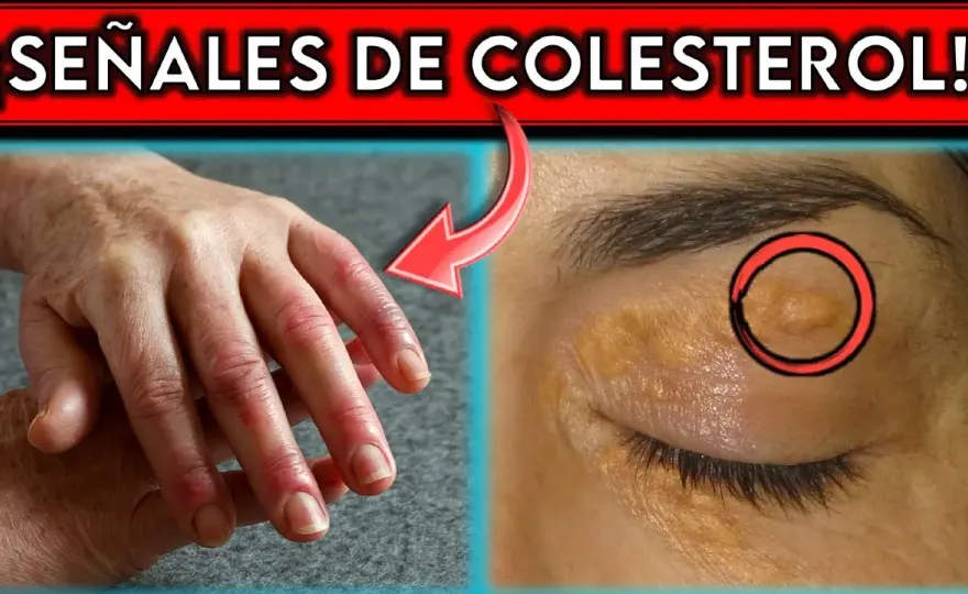 Síntomas de colesterol alto: ¿estás ignorando señales preocupantes?