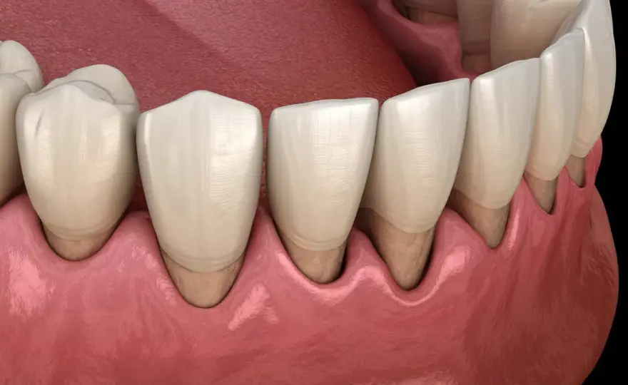 Cómo tratar la periodontitis y cuánto dura el tratamiento