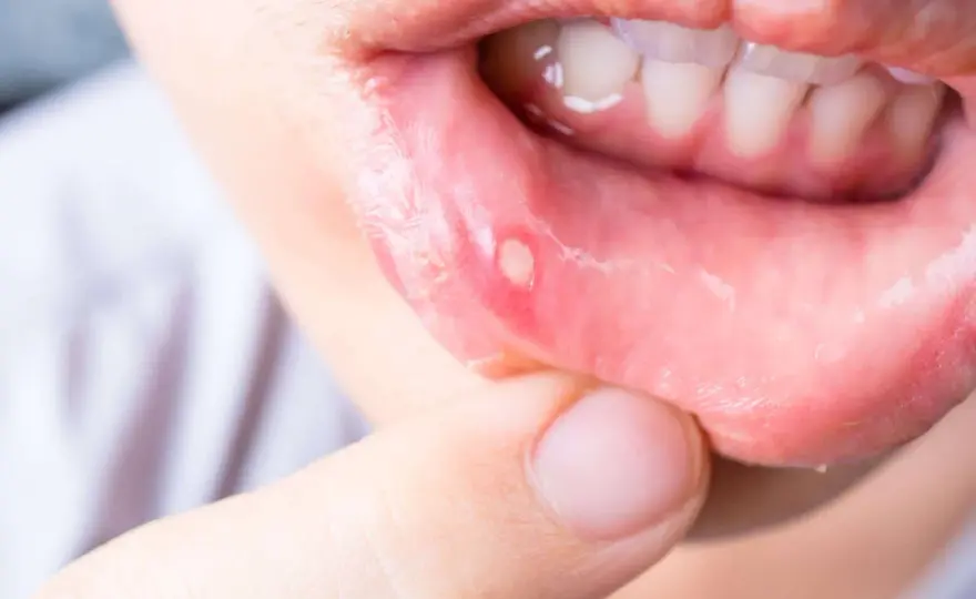 Afta dopo l’anestesia dal dentista? Cause e rimedi utili
