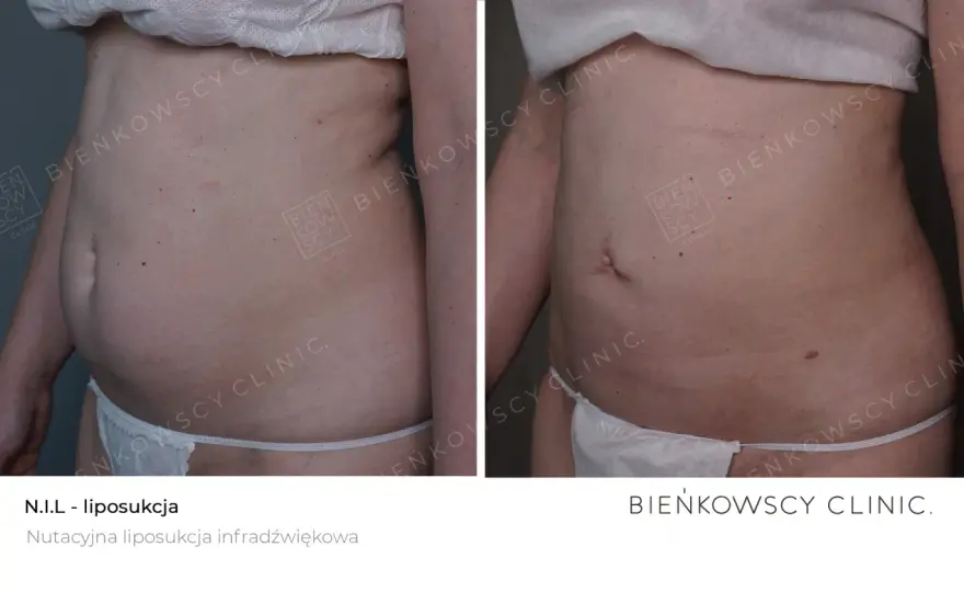Liposukcja: Co to? Metody, efekty, rekonwalescencja. Czy to dla Ciebie?
