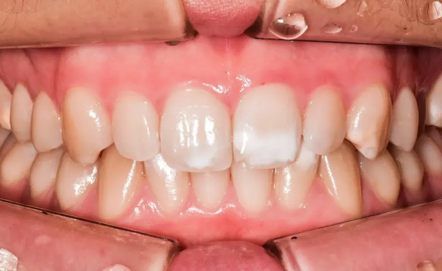 Macchia bianca sul dente - cause e cosa fare
