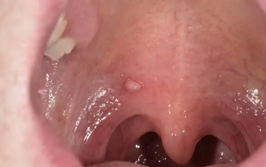 Objawy HPV w jamie ustnej: Jak rozpoznać i uniknąć poważnych problemów