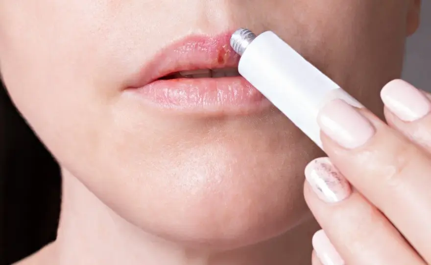 Afta labial o herpes? Cómo reconocerla y aliviar el dolor