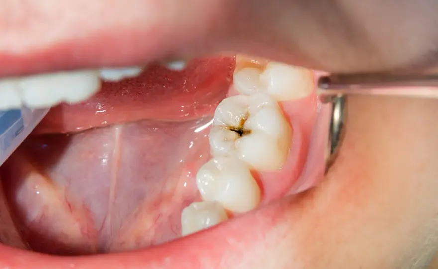 Caries bajo la encía - cómo reconocerla y tratarla