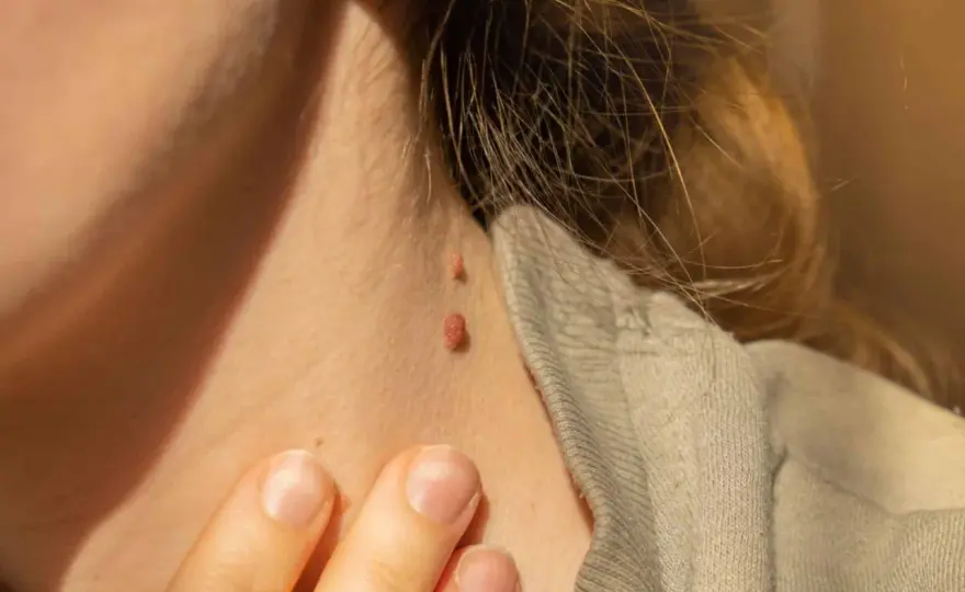 ¿Verrugas en el cuello? Distingue y retira con seguridad