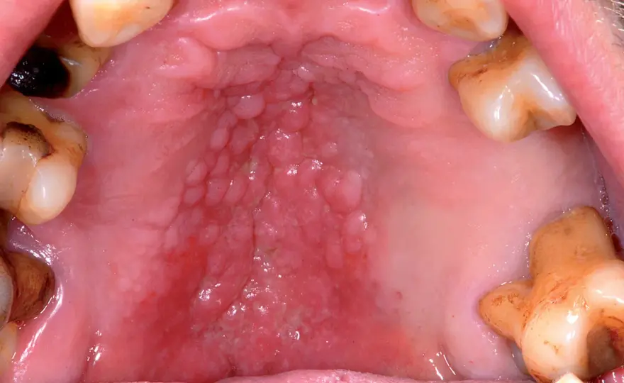 Mucosa orale che cambia? Segnali, cause e quando agire.