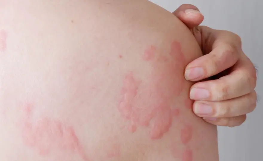 Orticaria nei bambini - cosa fare e quando preoccuparsi