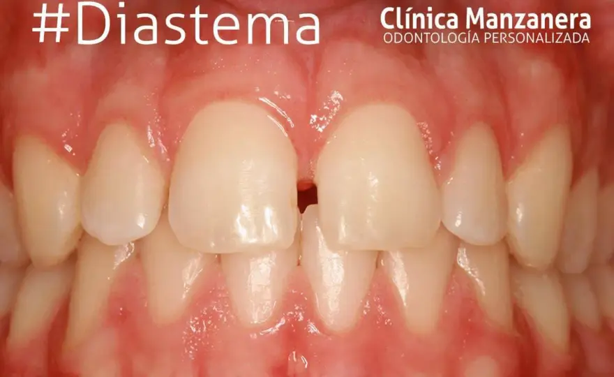 ¿Los brackets pueden cerrar los dientes separados?