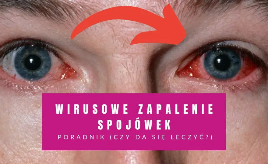 Wirusowe zapalenie spojówek - Rozpoznaj, lecz i chroń bliskich!