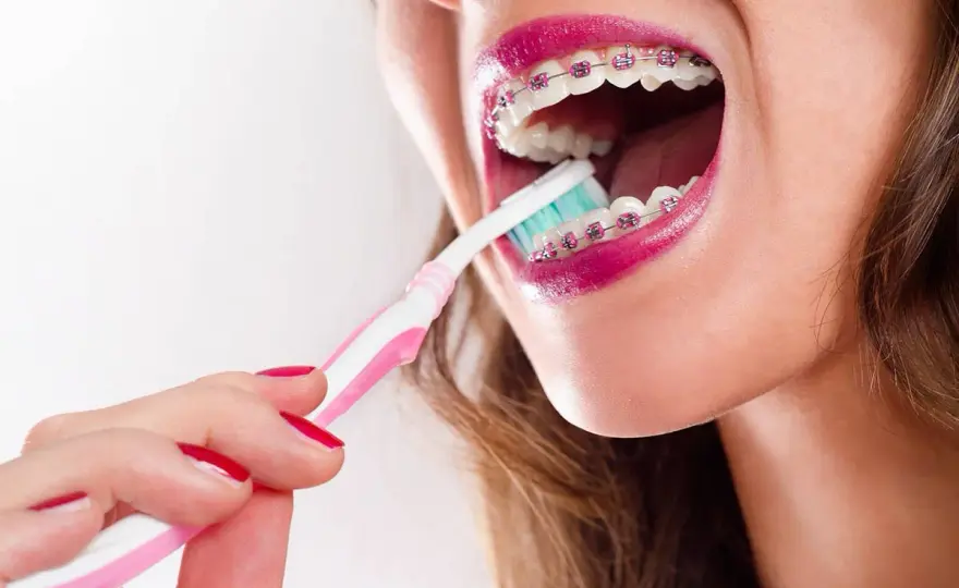 Cómo limpiar los brackets transparentes sin manchas ni caries