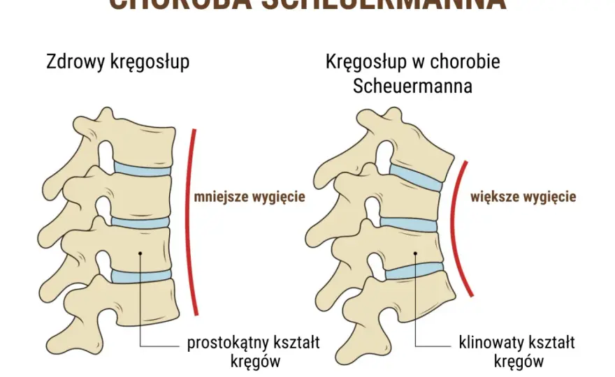 Kifoza Scheuermanna u dorosłych - co naprawdę pomaga?