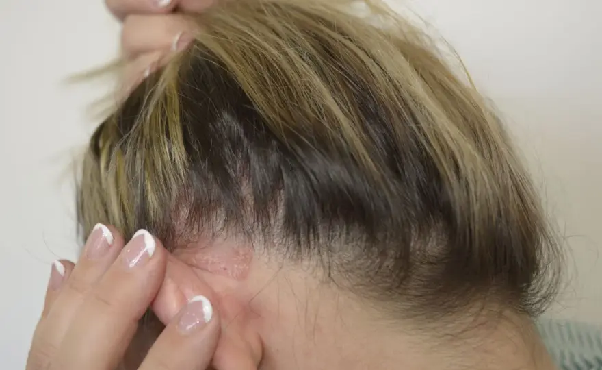 Ból skóry głowy i wypadanie włosów - Kiedy do dermatologa?