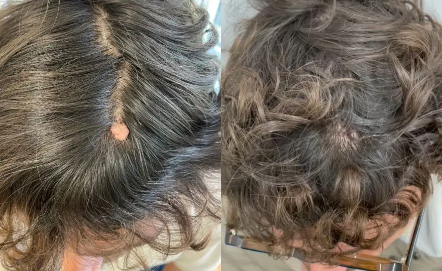 Verrugas en la cabeza - ¿Cuándo preocuparse y qué hacer?