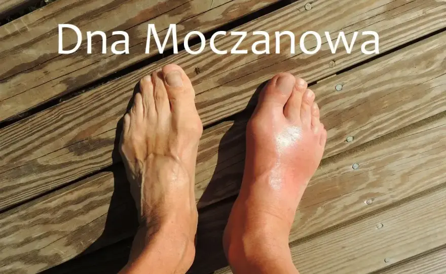 Artretyzm, czyli dna moczanowa - jak rozpoznać i opanować napad?
