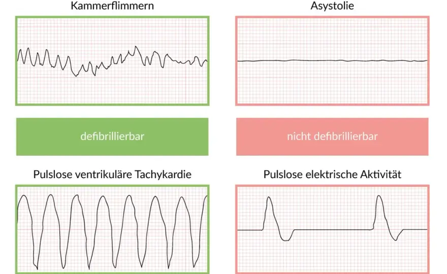 Lebenserwartung nach Reanimation - was wirklich zählt