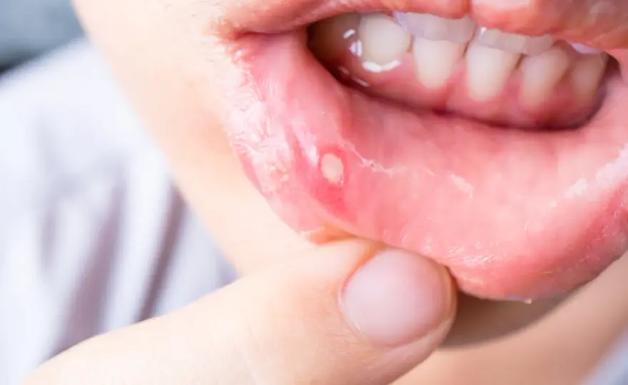 Vesciche in bocca, afta o herpes? Come riconoscerle