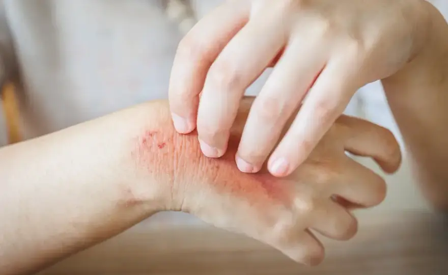 Micosis cutáneas - ¿Cómo diferenciarlas y tratarlas bien?